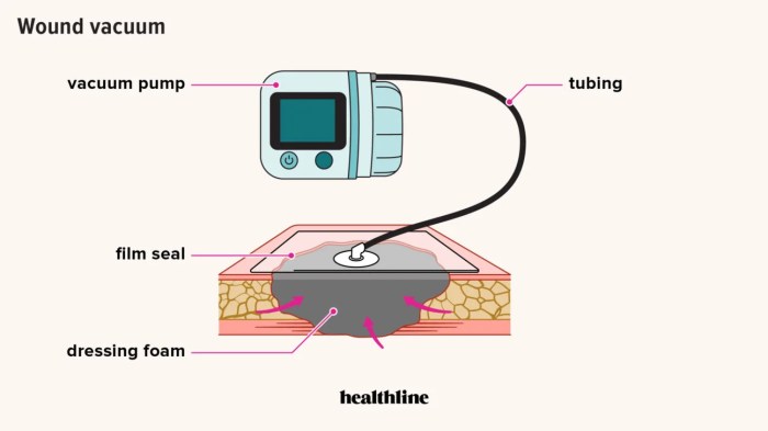 Cpt for wound vac change