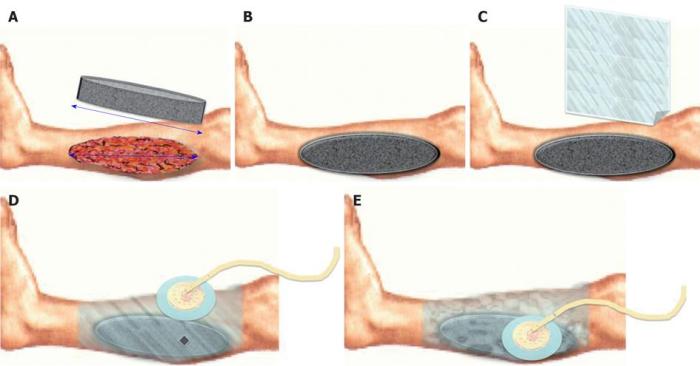 Vac wound dressing change